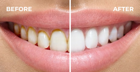 Before and after smile comparison