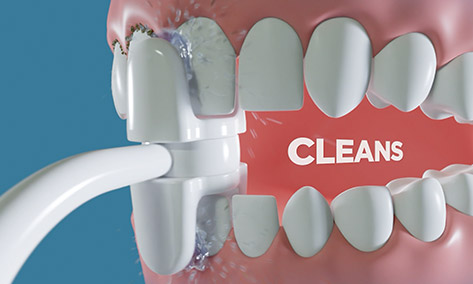 Cleaning plaque off teeth