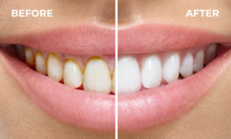 Before and after of clean teeth